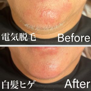 電気脱毛大阪