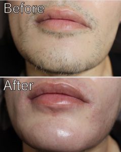 ヒゲニードル脱毛メンズ