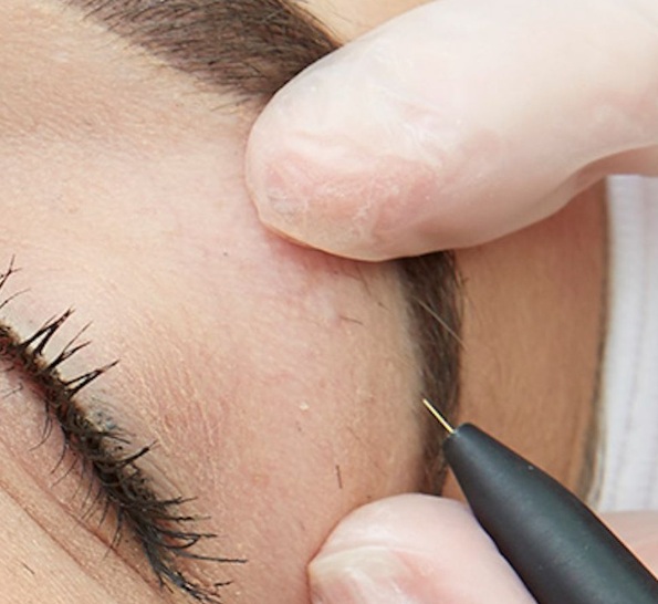 Eyebrow Electrolysis Hair Removal in Osaka